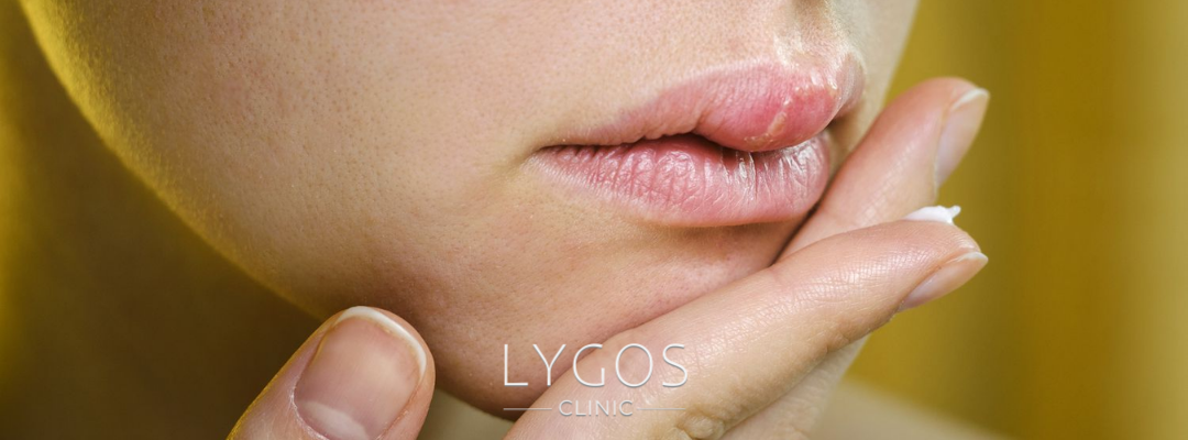 Lip Lift Surgery | Risks and Recovery 3 Risks and Side Effects of Lip Lift Surgery