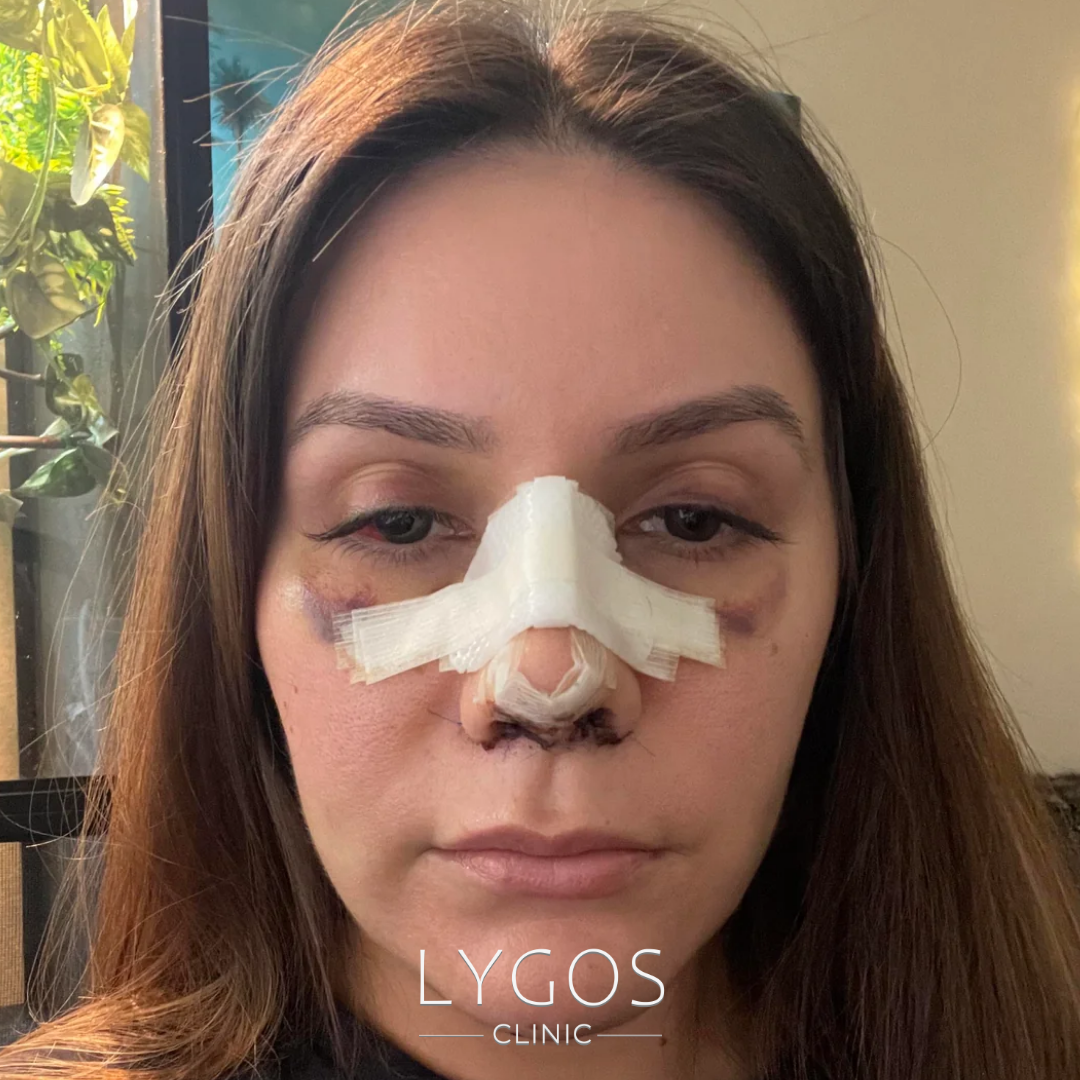 Swelling After Rhinoplasty | Causes and Solutions 1 Swelling After Rhinoplasty