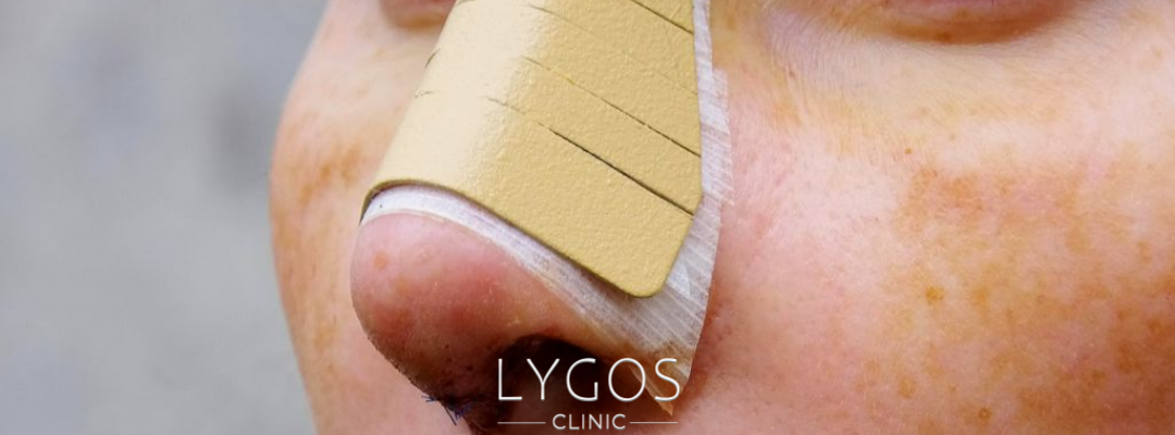 Burun Ateli Nedir | Burun Ateli Nasıl Kullanılır? 2 What is a Nasal Upper Splint (Nose Cast)?