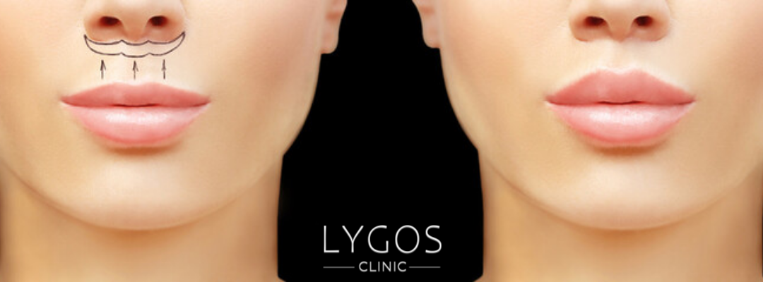 Lip Lift Surgery | Risks and Recovery 2 What is Lip Lift Surgery?