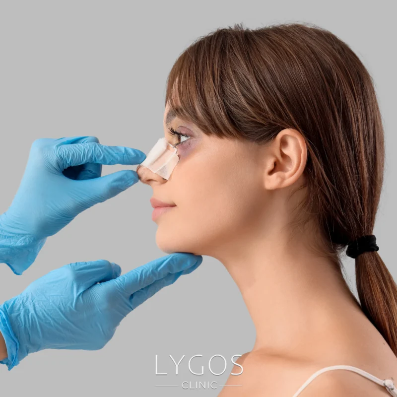 When Bruises Heal After Rhinoplasty