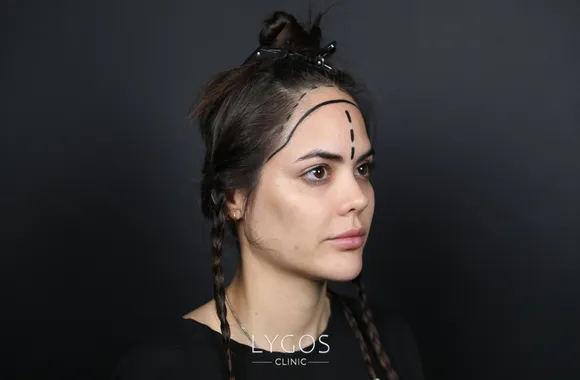 Saç Ekim Prosedürü 28 woman hair transplant hair transplant procedure 1