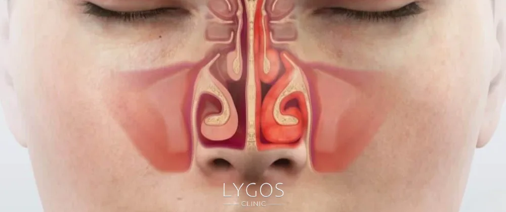 Nasal Turbinate Surgery | What Are the Risks? 2 What is Nasal Turbinate (Concha)?