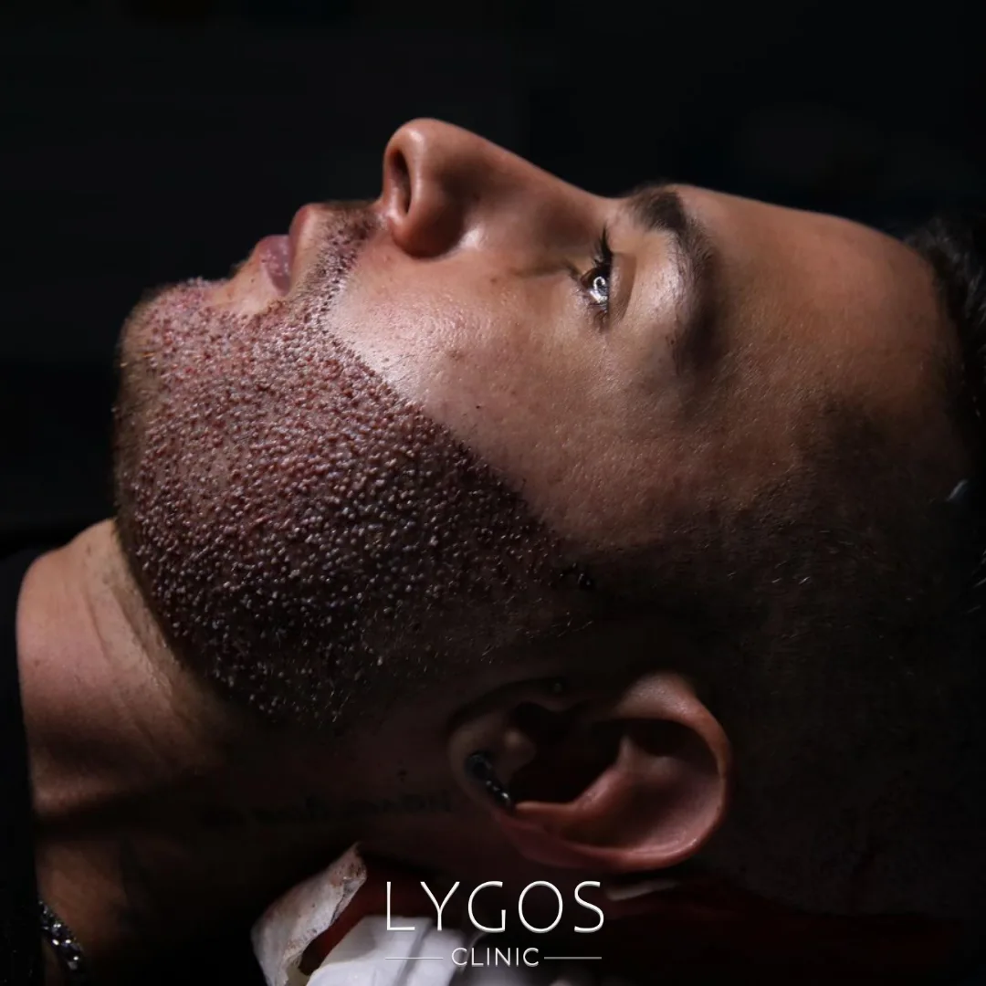 Who Is an Ideal Candidate for Beard Transplantation? 1 Who Is an Ideal Candidate for Beard Transplantation?
