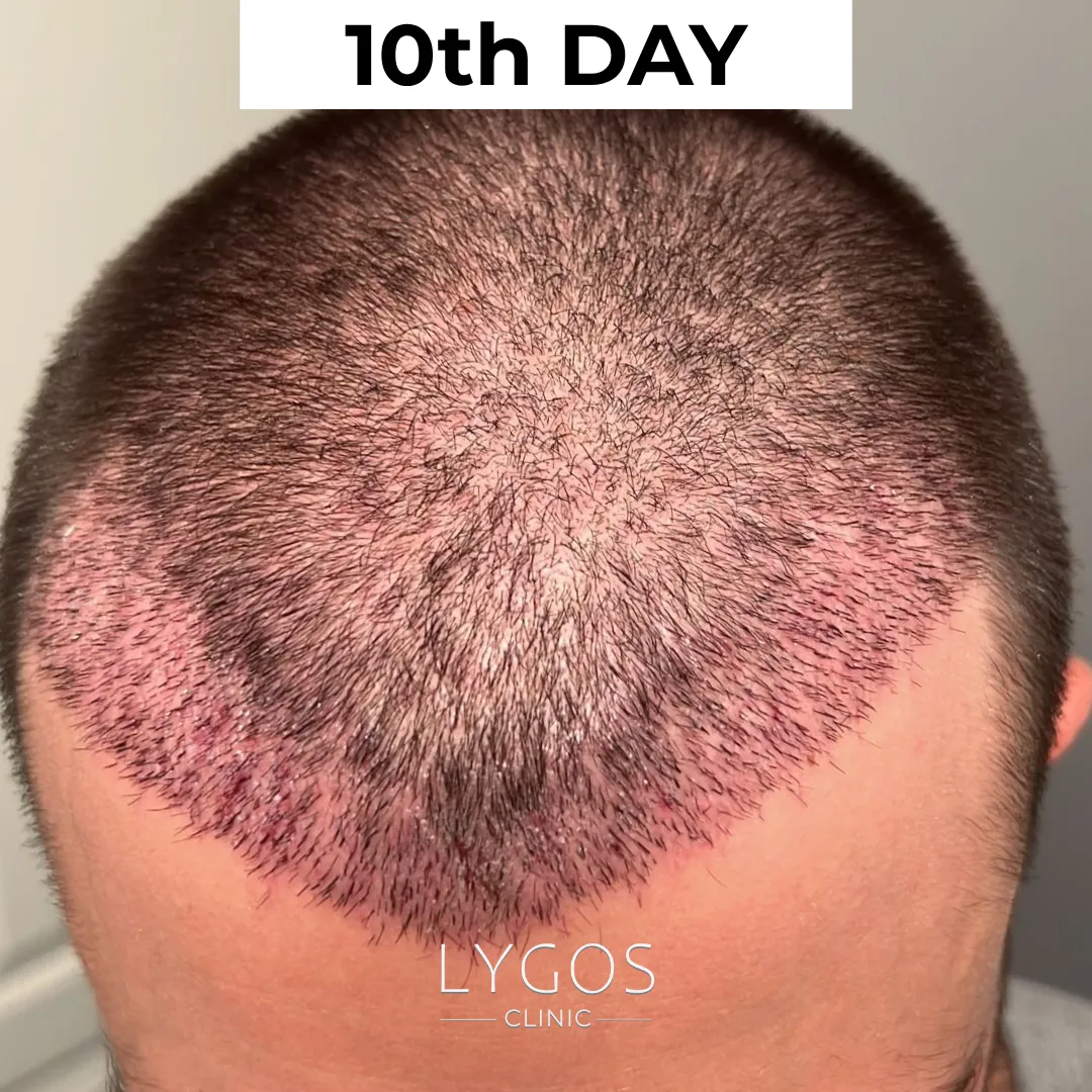 Saç Ekimi 37 after 10th day hair transplant