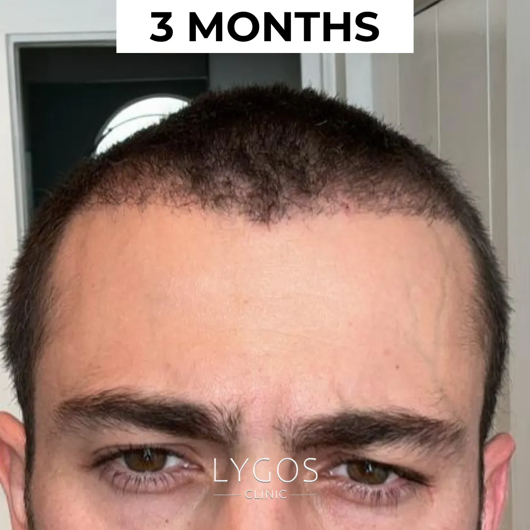 Saç Ekimi 38 after 3 months hair transplant