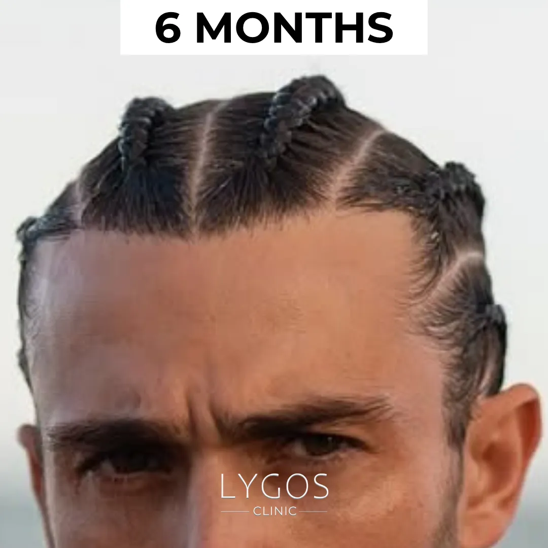 Saç Ekimi 39 after 6 months hair transplant