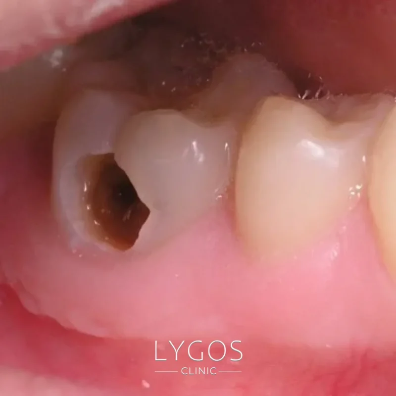 What Should I Do If My Tooth Filling Falls Out?