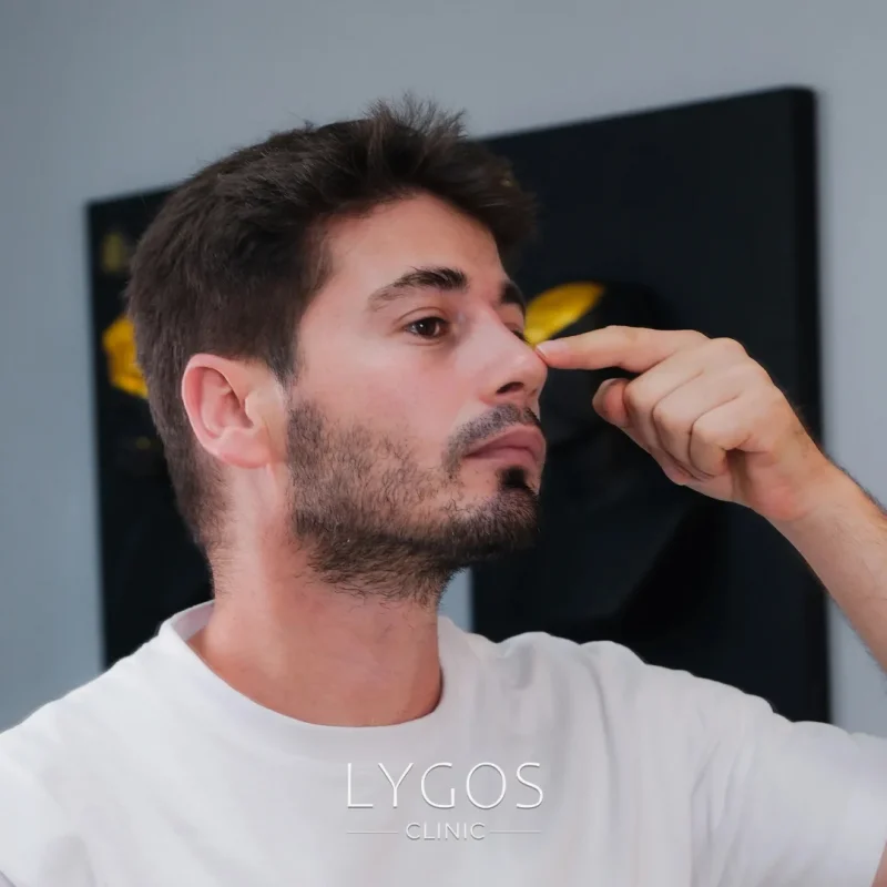 What Needs to Be Done After Rhinoplasty Surgery