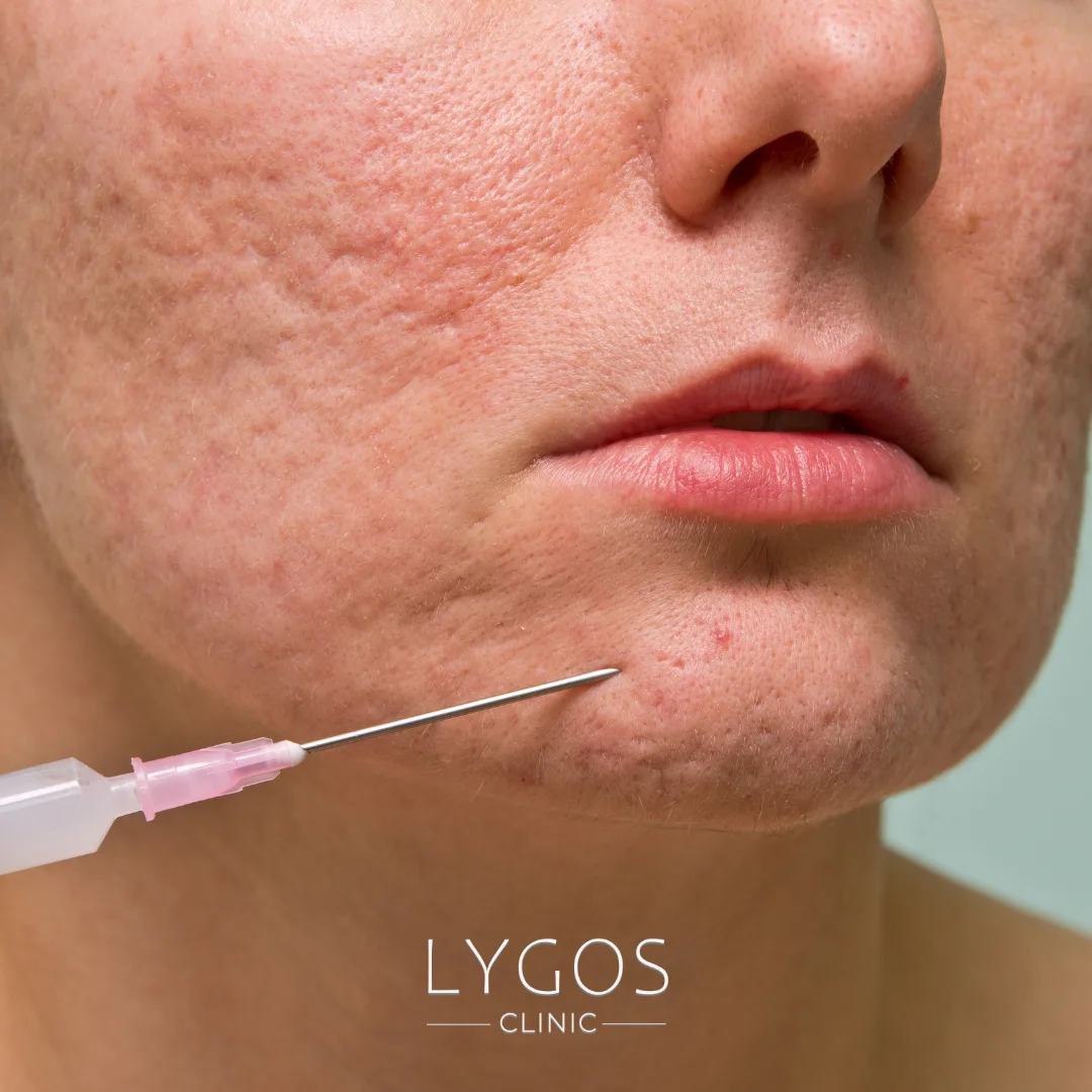 How to Get Rid of Pimples (Acne)? 1 How to Get Rid of Pimples