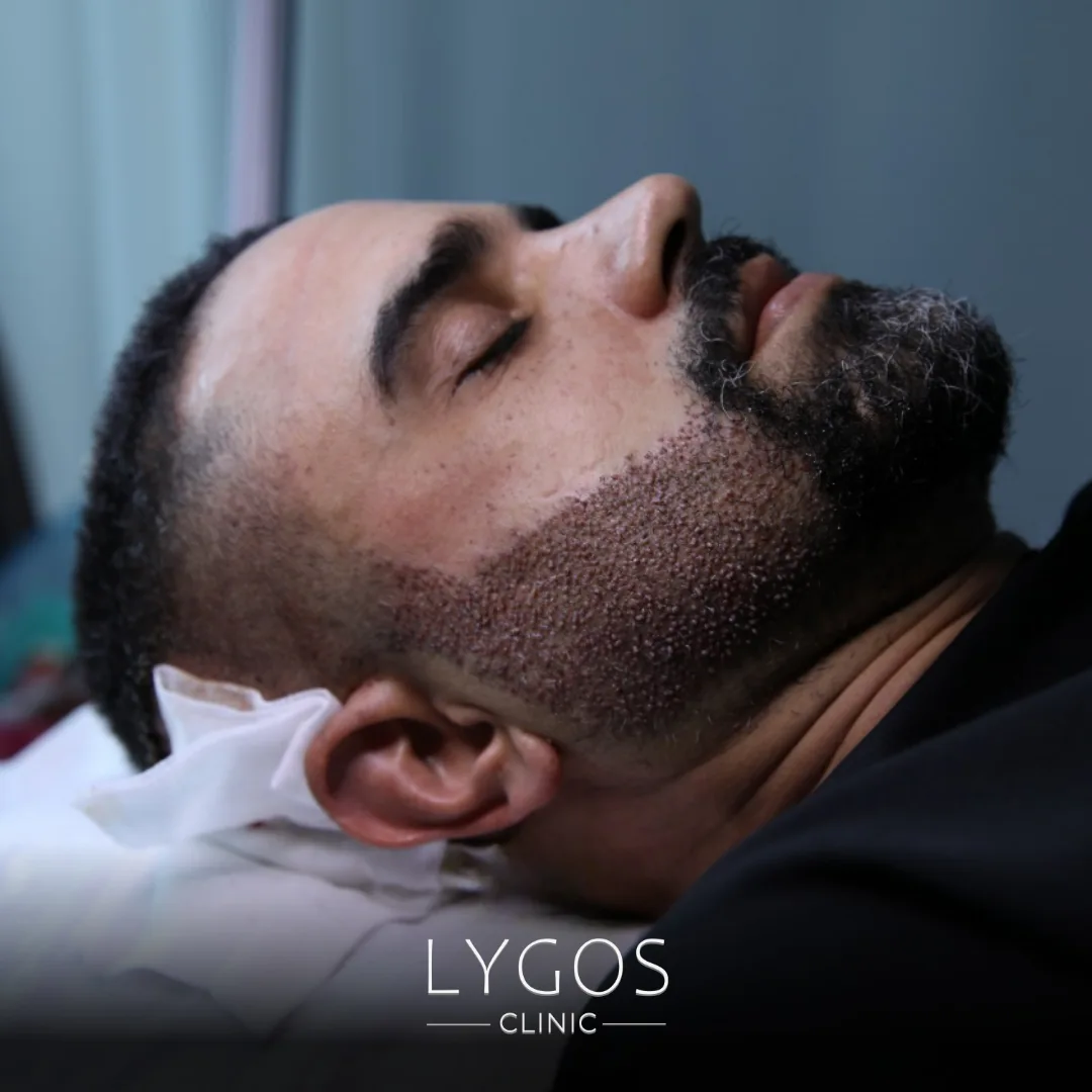 Sakal Ekimi Sonrası Dikkat Edilmesi Gerekenler 1 Things to Consider After Beard Transplantation