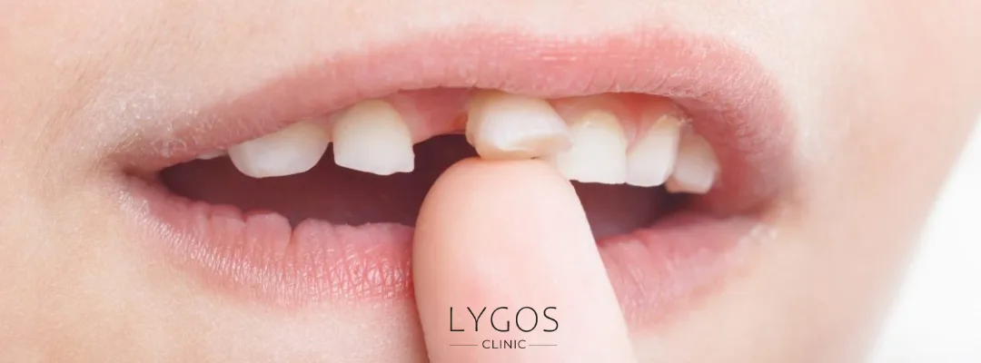 What Causes a Loose Tooth? 2 What Is a Loose Tooth?
