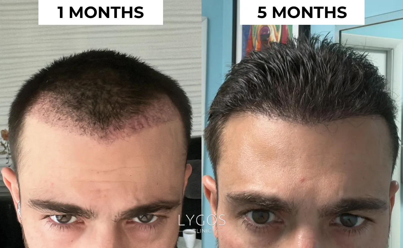Saç Ekimi 42 EDEMA AFTER HAIR TRANSPLANT
