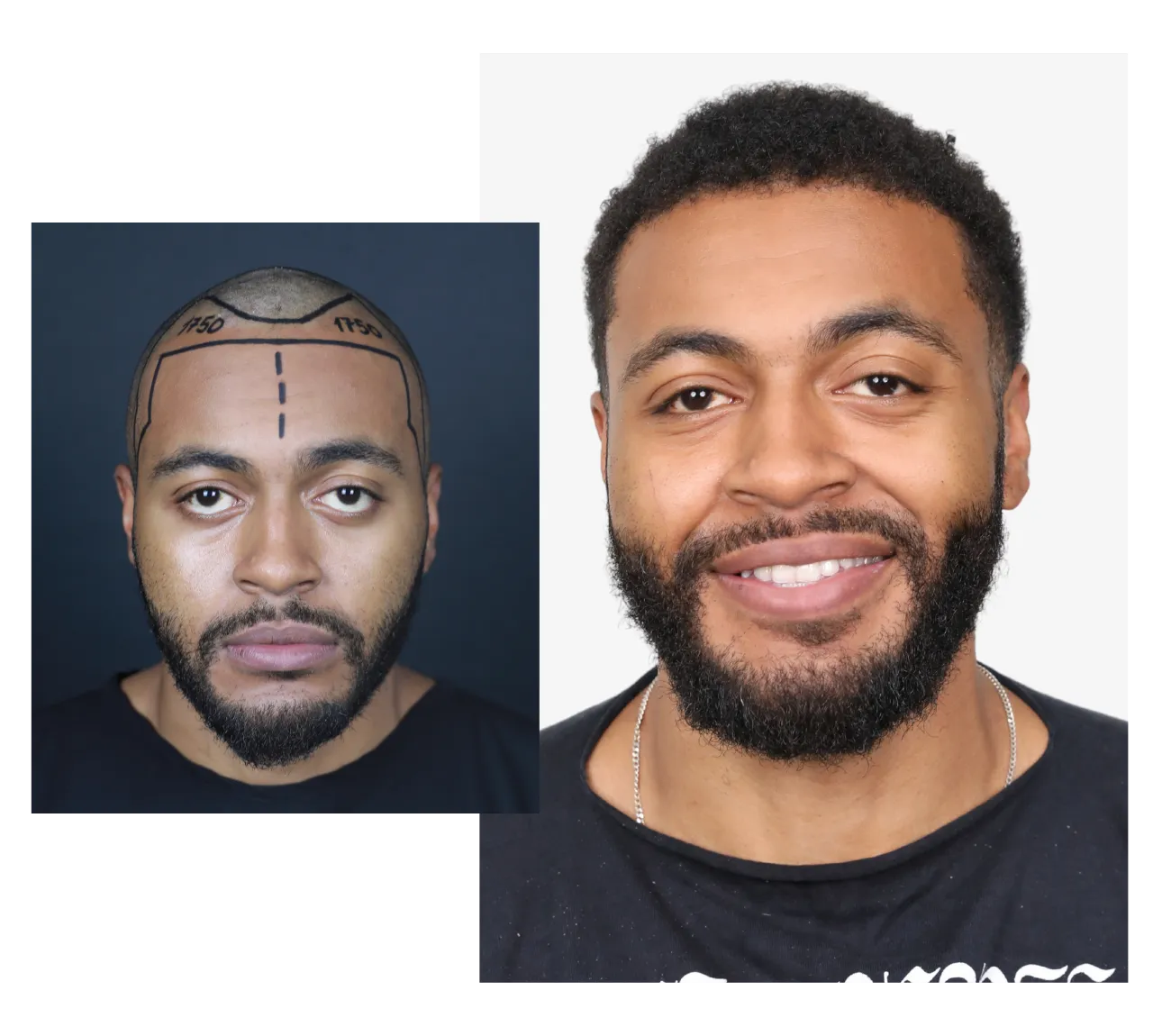 Saç Ekimi 32 afro hair transplant before and after