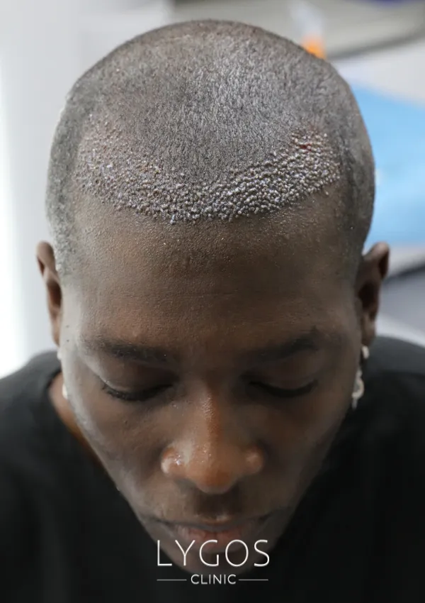 Saç Ekimi 34 afro hair transplant implantation and hair design