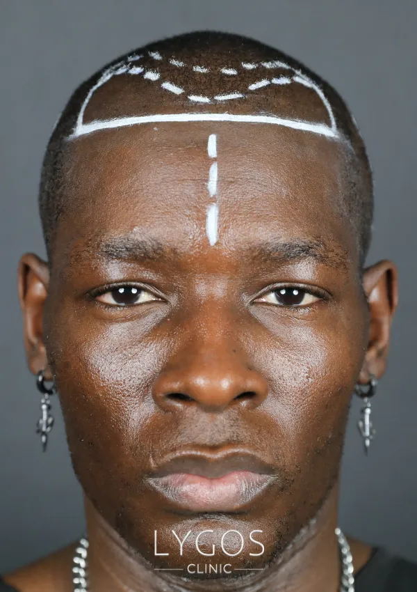 Saç Ekimi 33 afro hair transplant implantation and hair design