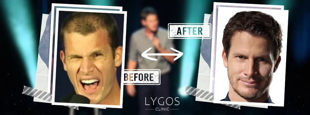 Daniel Tosh Hair Transplant | Celebrities Hair Transplant 4 Daniel Tosh Before and After Hair Transplant