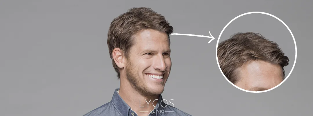 Daniel Tosh Hair Transplant | Celebrities Hair Transplant 3 Did Daniel Tosh Get a Hair Transplant?