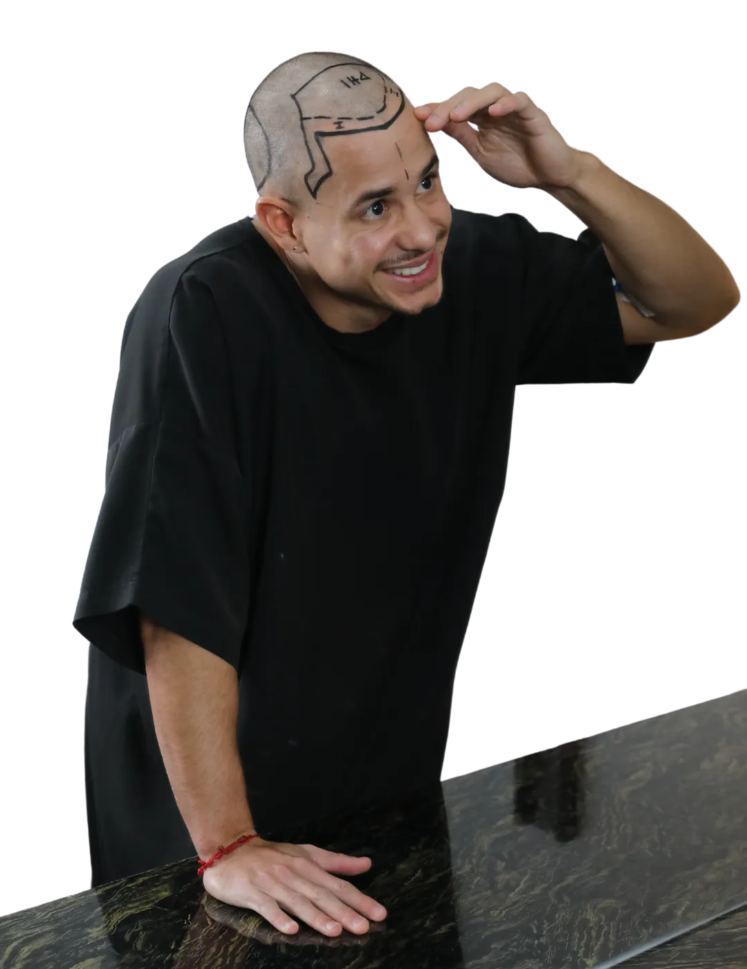 dhi hair transplant