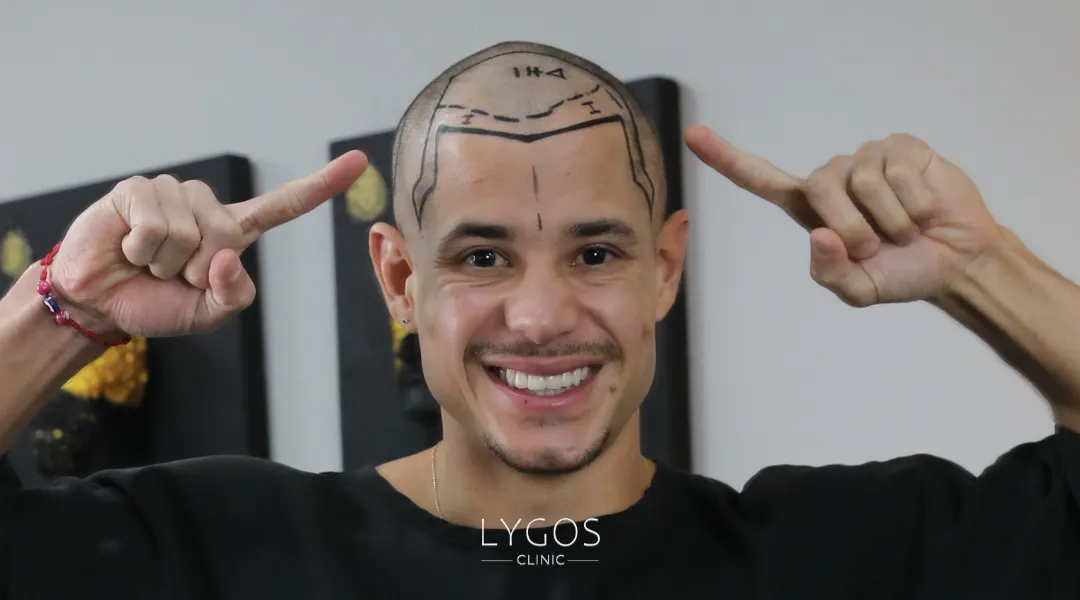 Saç Ekimi 24 dhi hair transplant hair line