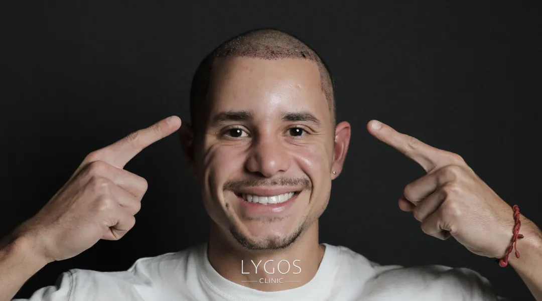 Saç Ekimi 25 dhi hair transplant transplantation