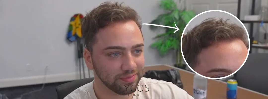 Did Mizkif Get a Hair Transplant?