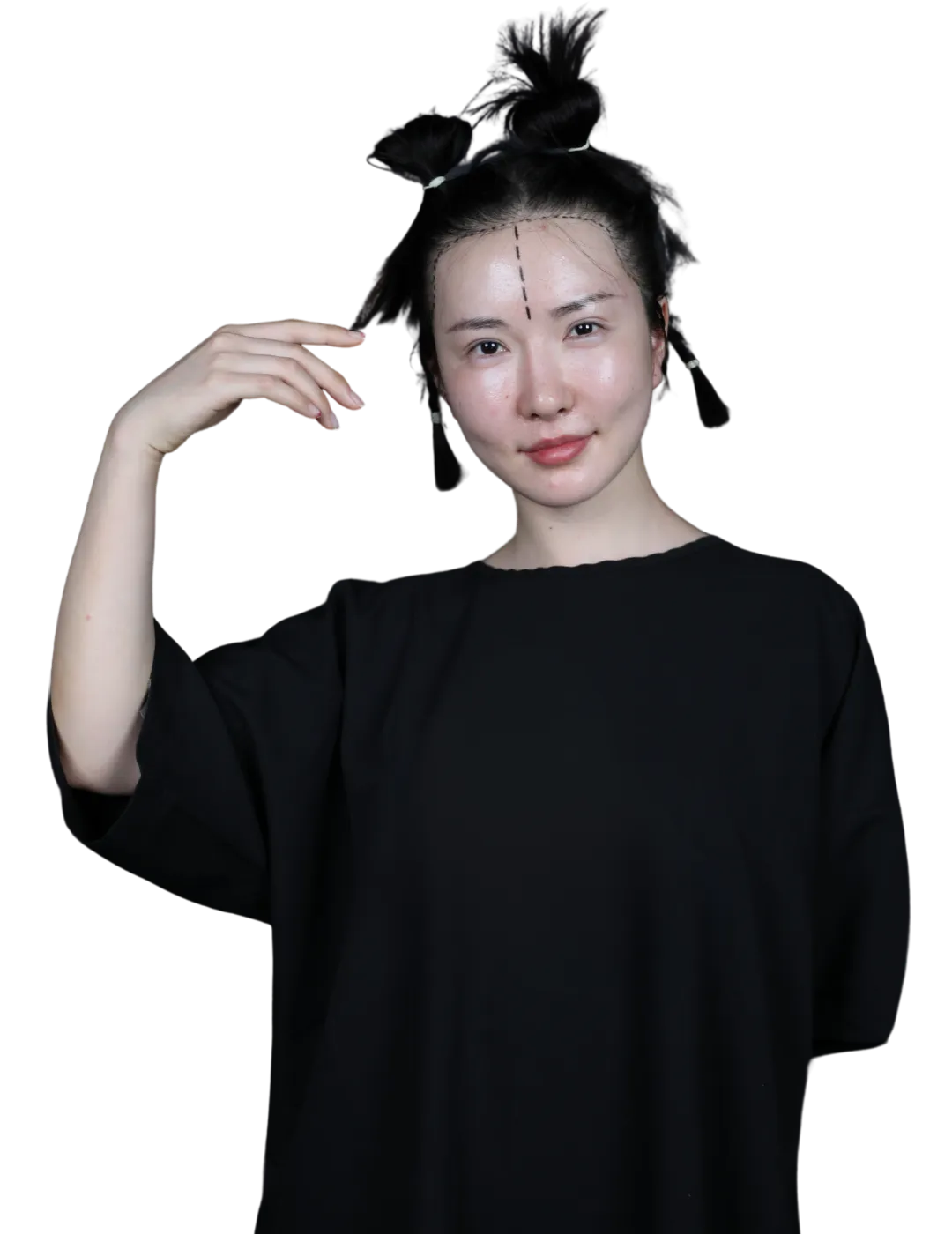 female hair transplant