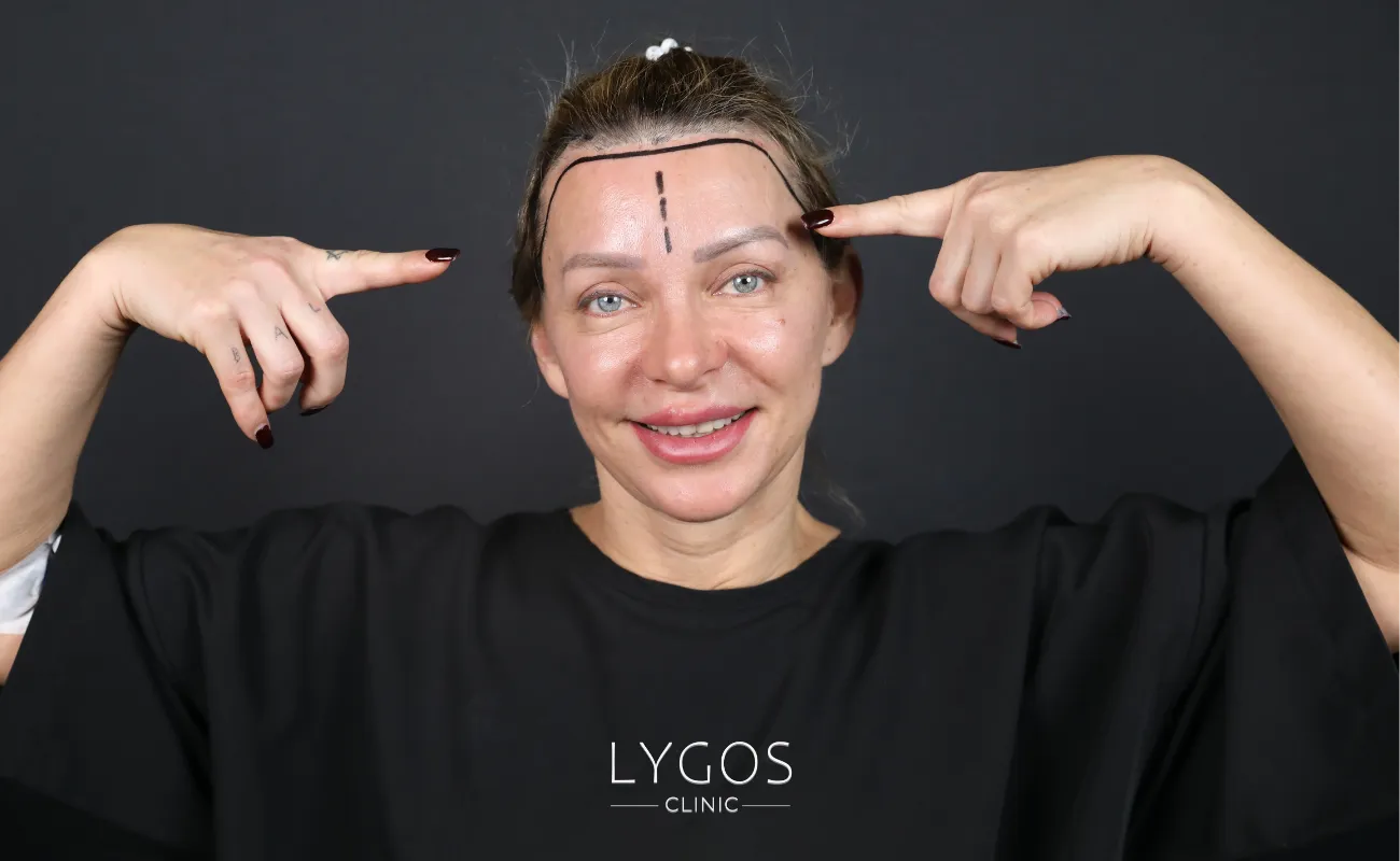 Saç Ekimi 30 female hair transplant