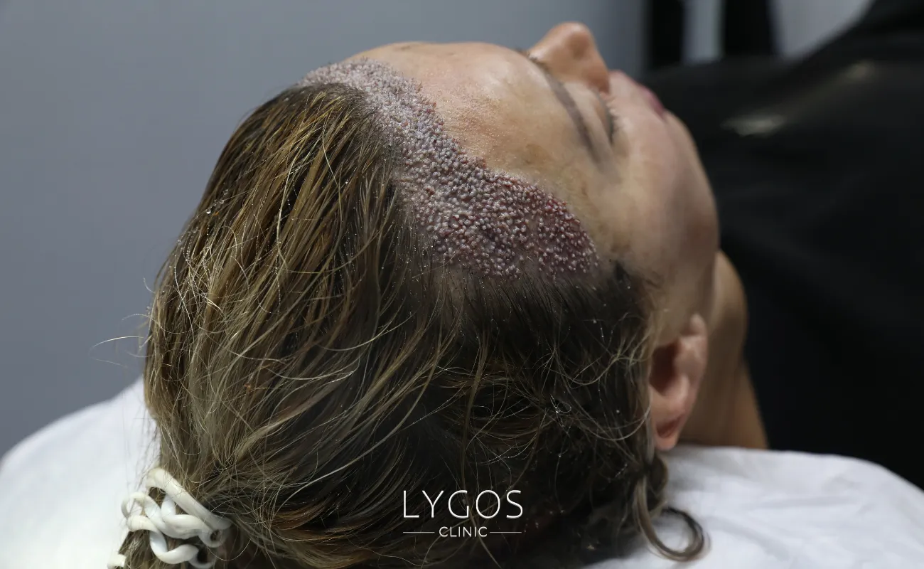 Saç Ekimi 31 female hair transplant