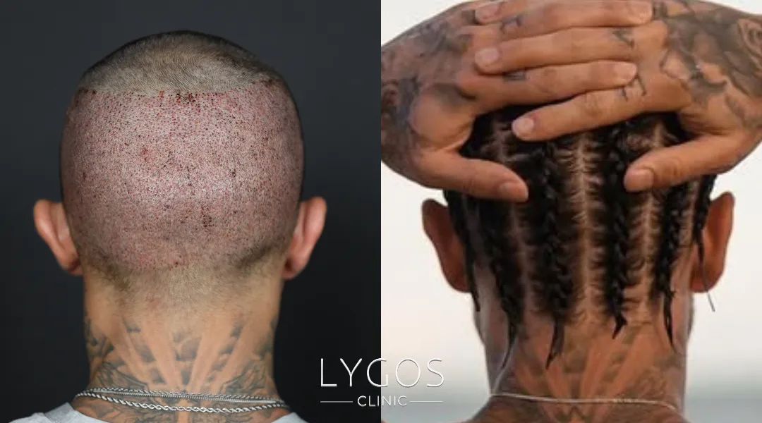 Saç Ekimi 40 hair transplant donor area
