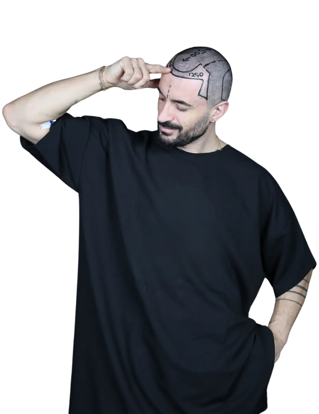 hybrid hair transplant