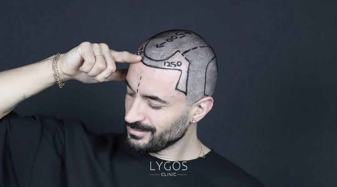 Saç Ekimi 26 hybrid hair transplant hair line