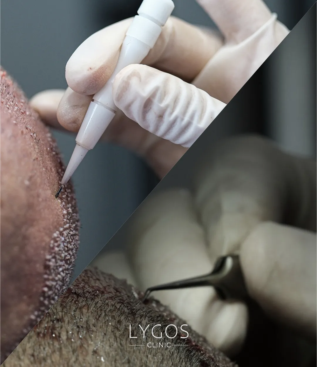 hybrid hair transplant mp1