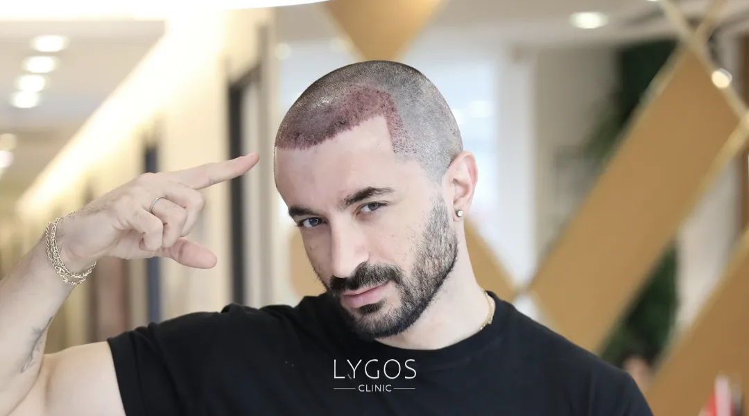 Saç Ekimi 27 hybrid hair transplant transplantation