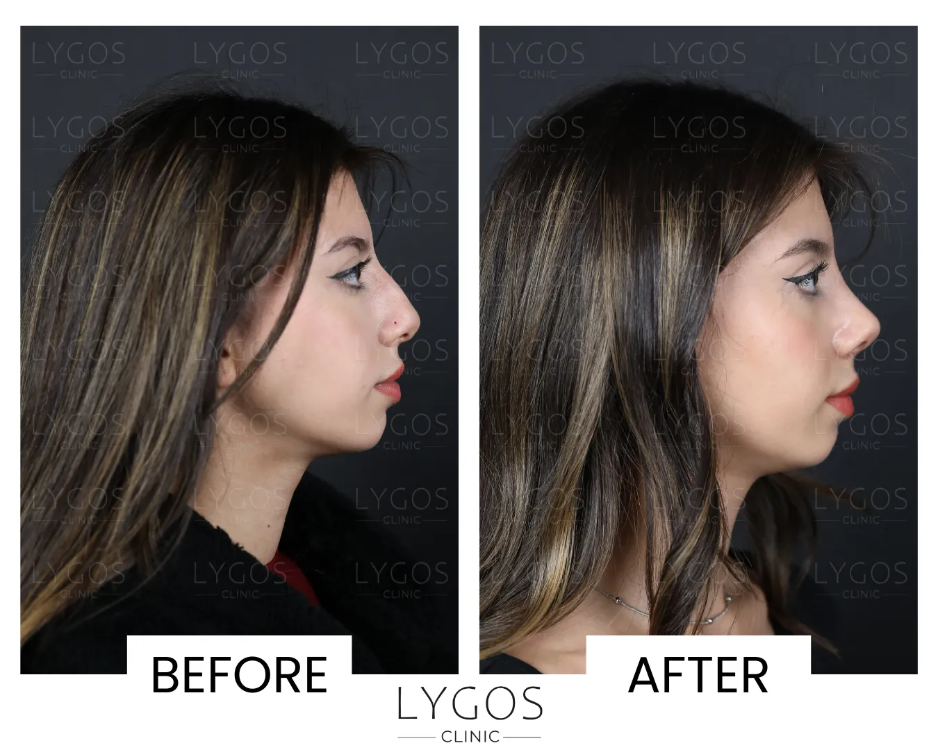 Rhinoplasty 14 lygos clinic rhinoplasty before and after pictures
