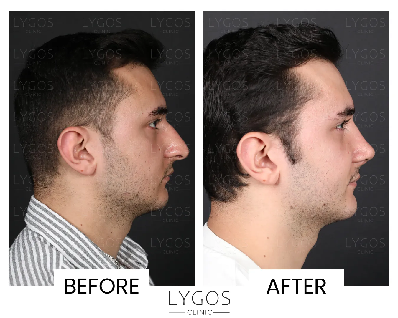Rhinoplasty 20 lygos clinic rhinoplasty before and after pictures