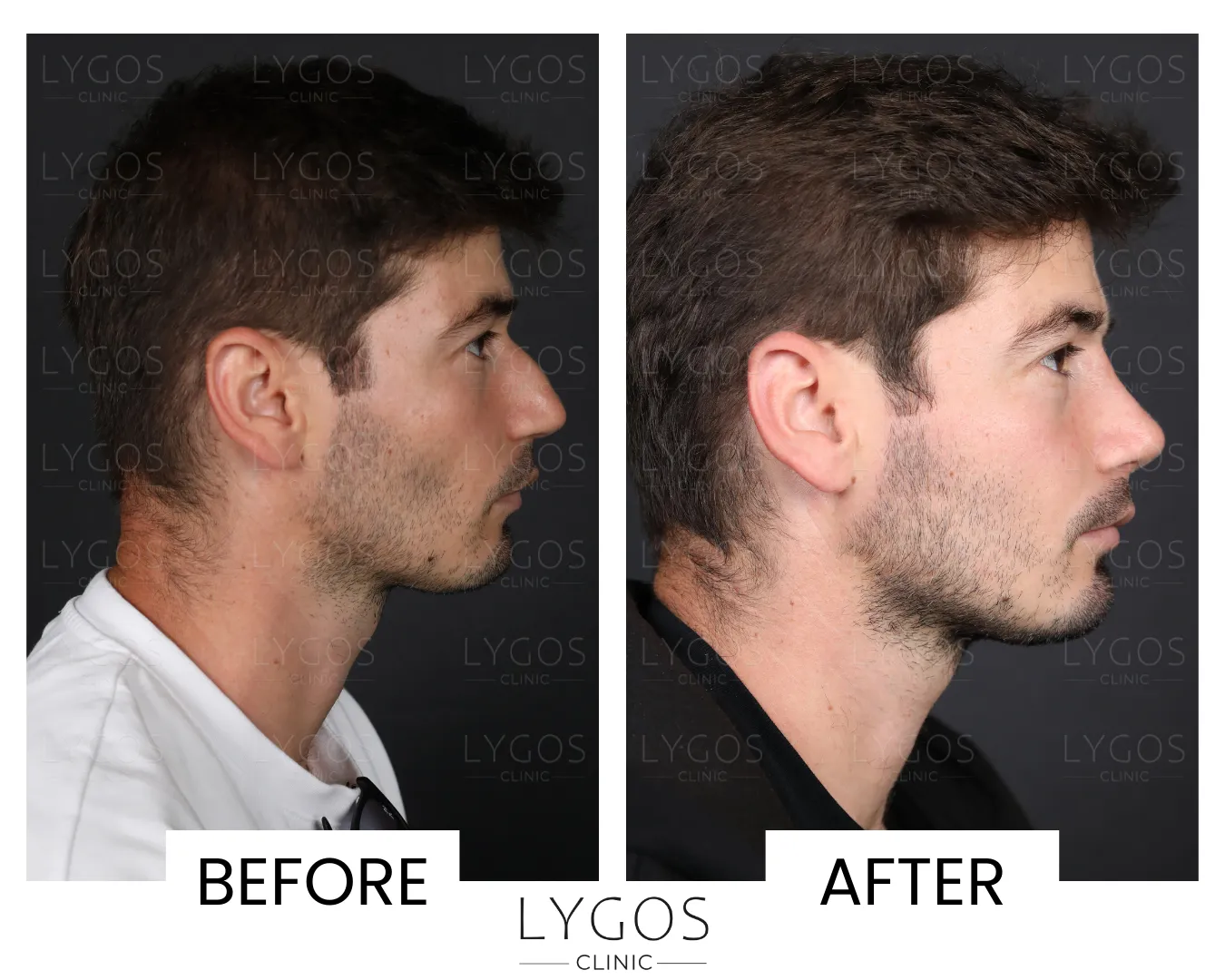 Rhinoplasty 21 lygos clinic rhinoplasty before and after pictures