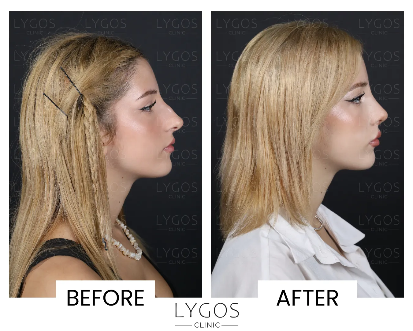 Rhinoplasty 11 lygos clinic rhinoplasty before and after pictures