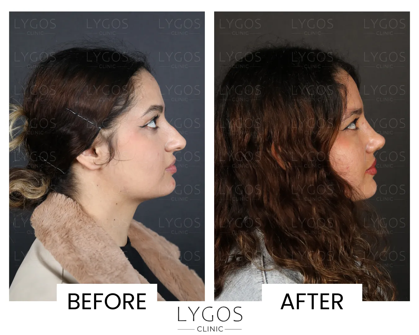 Rhinoplasty 17 lygos clinic rhinoplasty before and after pictures