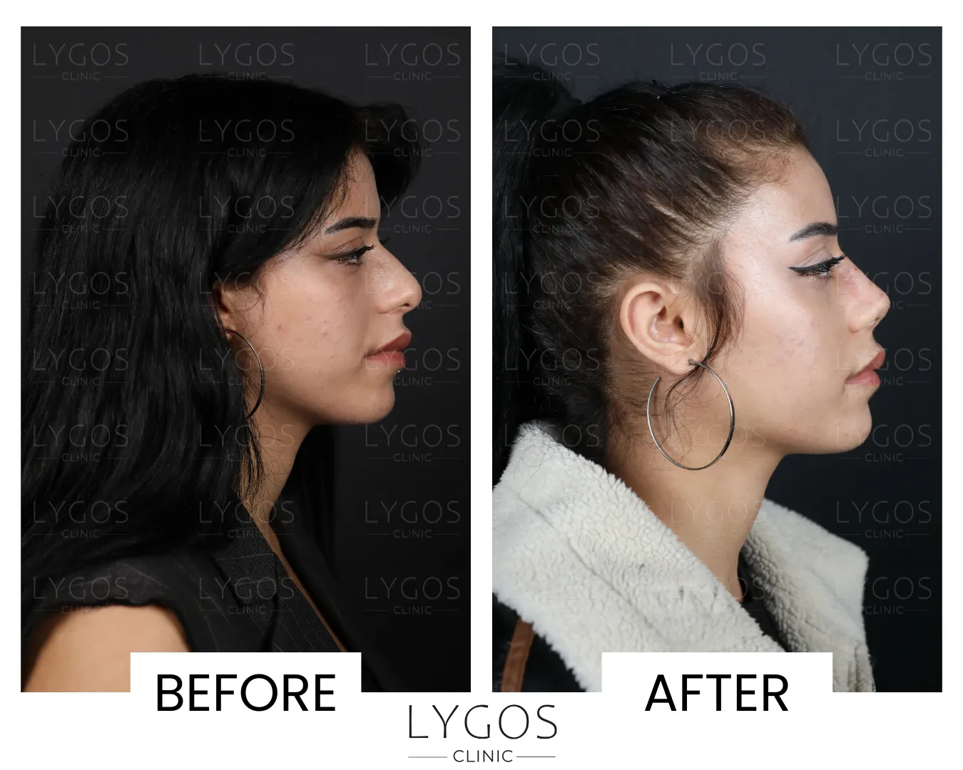 Rhinoplasty 15 lygos clinic rhinoplasty before and after pictures