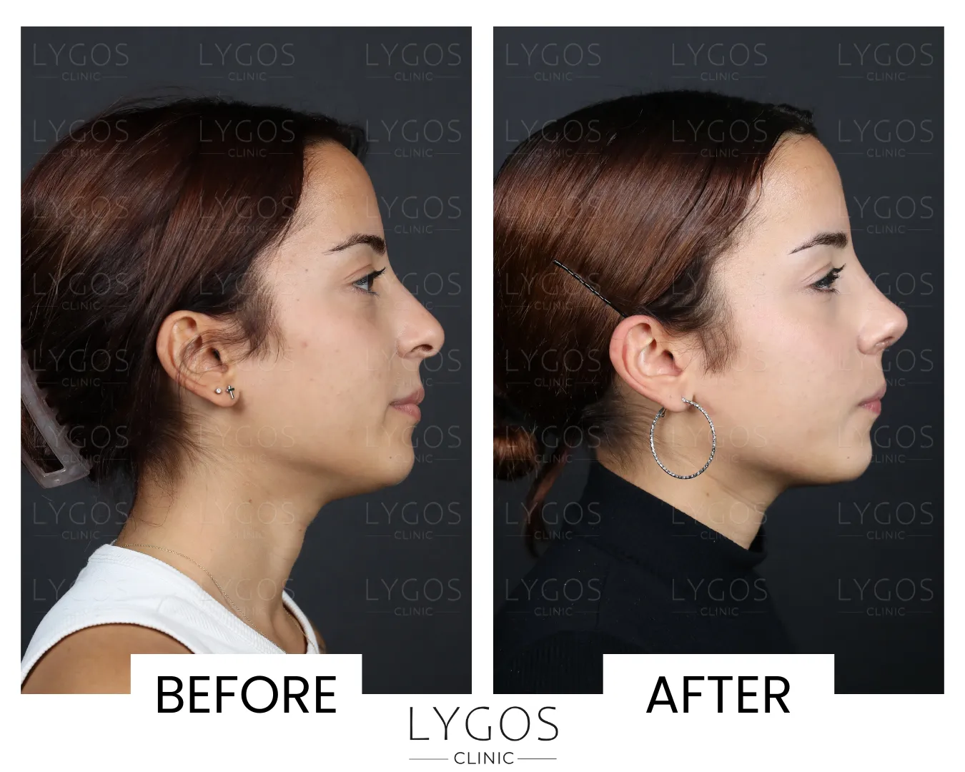 Rhinoplasty 10 lygos clinic rhinoplasty before and after pictures