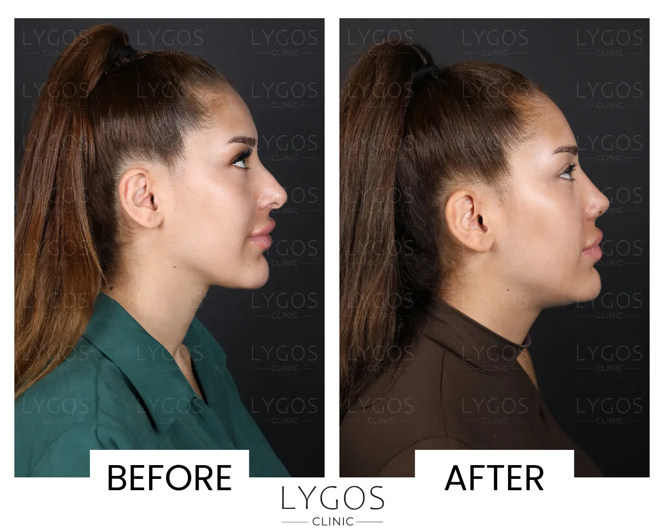 Rhinoplasty 16 lygos clinic rhinoplasty before and after pictures