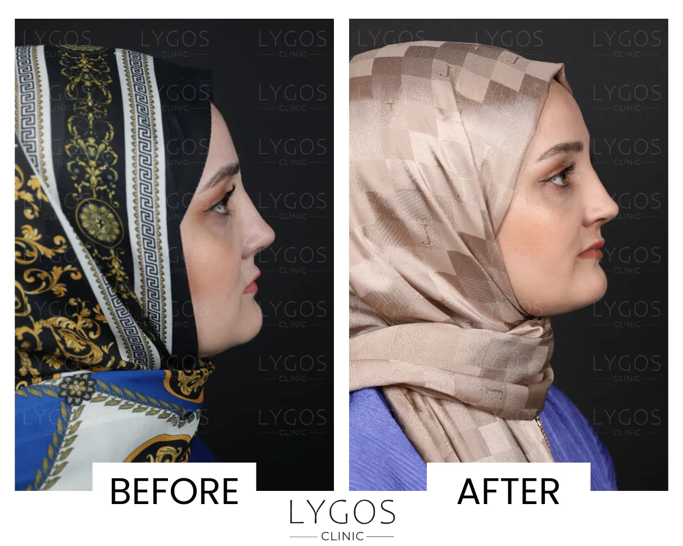 Rhinoplasty 18 lygos clinic rhinoplasty before and after pictures