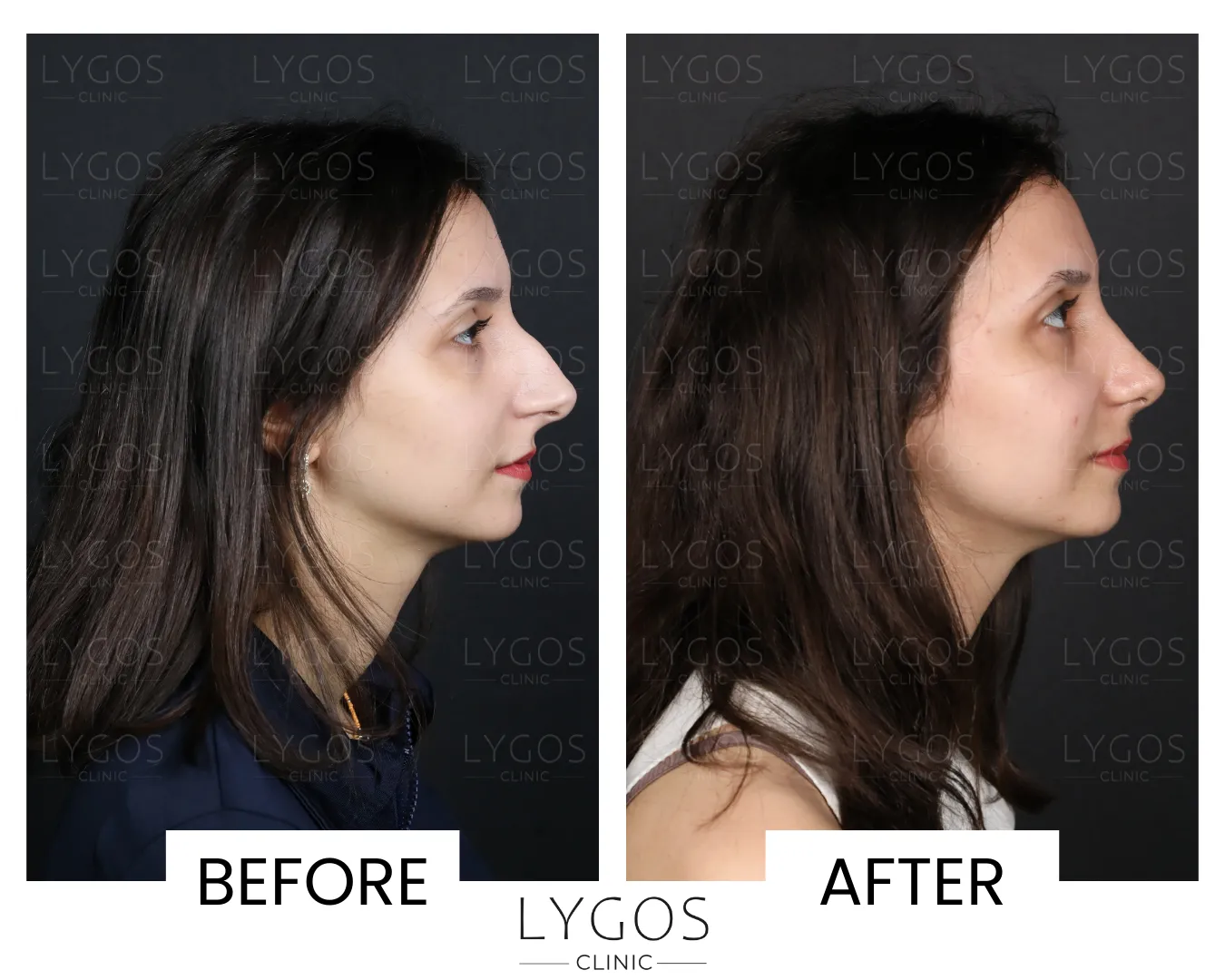 Rhinoplasty 13 lygos clinic rhinoplasty before and after pictures