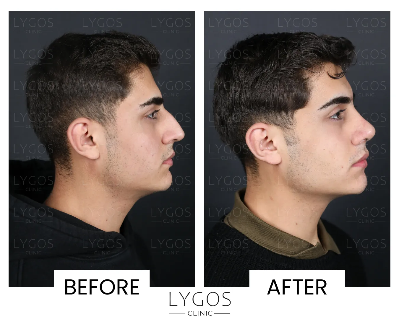 Rhinoplasty 12 lygos clinic rhinoplasty before and after pictures