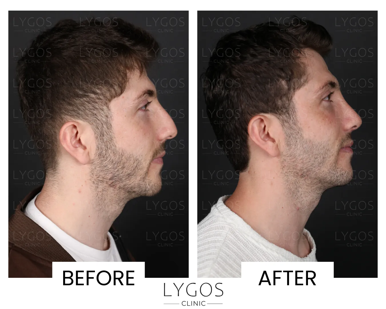 Rhinoplasty 19 lygos clinic rhinoplasty before and after pictures