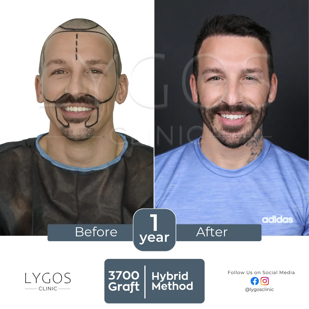 Saç Ekimi 19 lygos hair transplant before and after images