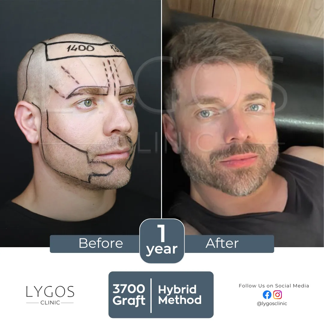 Saç Ekimi 16 lygos hair transplant before and after images