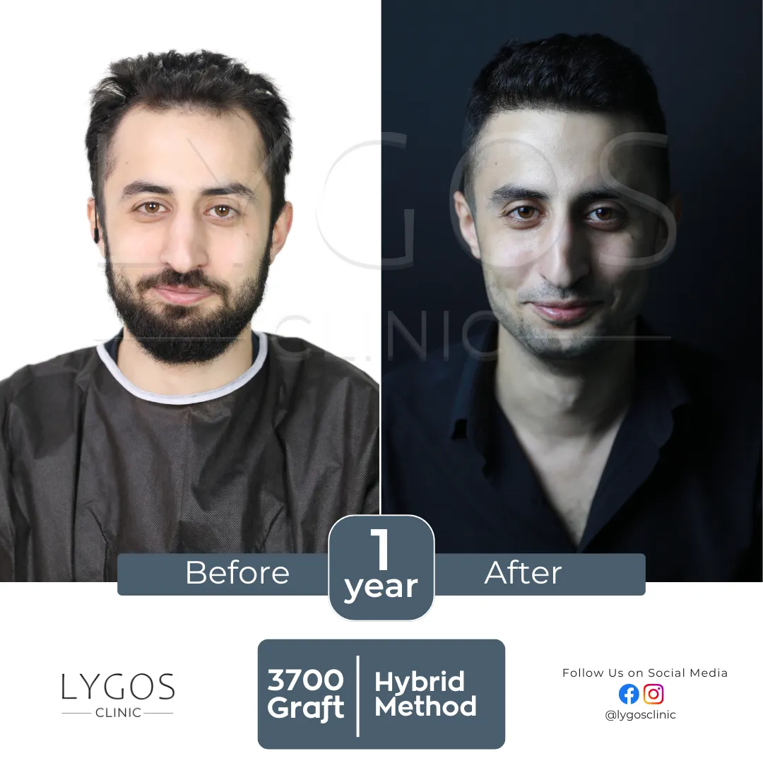 Saç Ekimi 17 lygos hair transplant before and after images