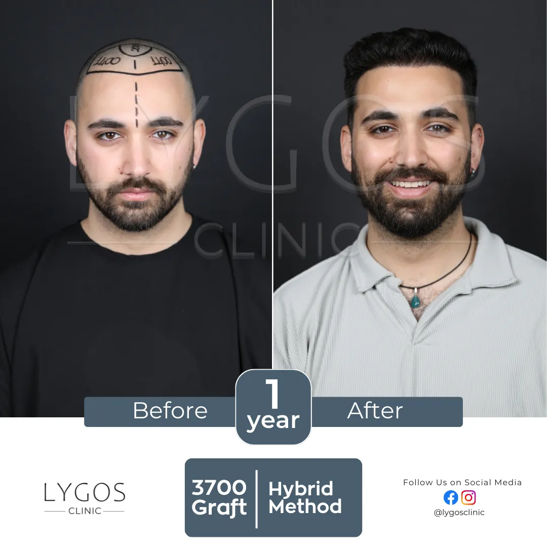 Saç Ekimi 18 lygos hair transplant before and after images